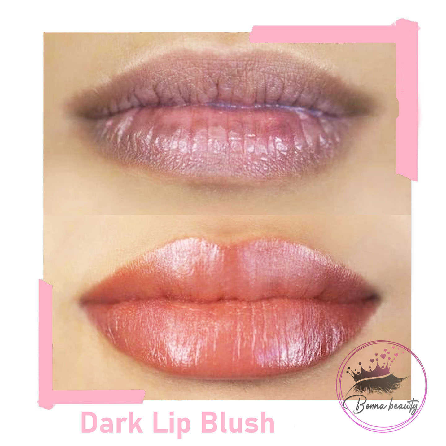 How to neutralize dark lips colours? How much dose it cost?
